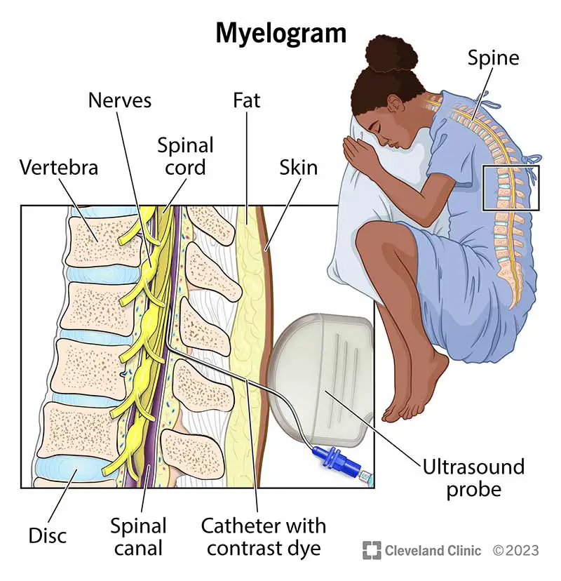 4892 myelogram