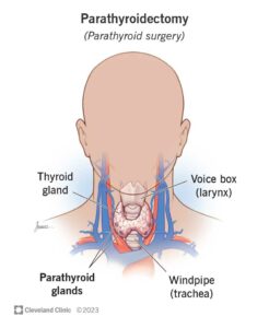 7015 parathyroid surgery