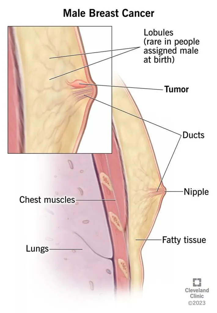 9011 male breast cancer