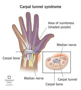 carpal tunnel syndrome