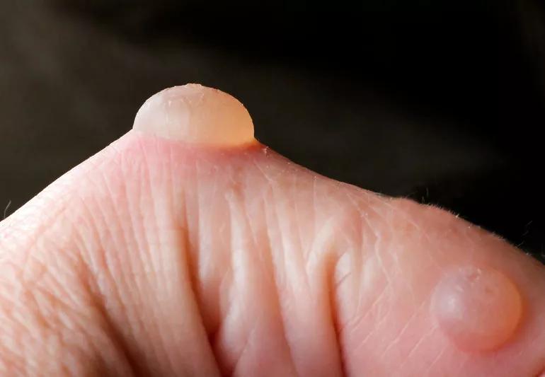 closeup Blister Hand 170617489 770x553 1 jpg