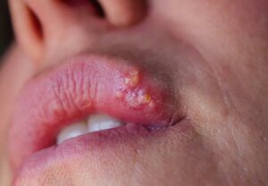 cold Sore Lip 1485050089 770x533 1 jpg