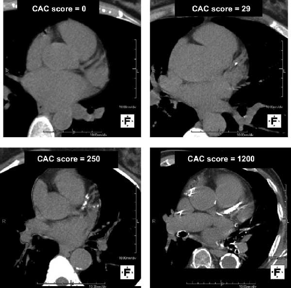 noncontrast coronary calcium CT scans