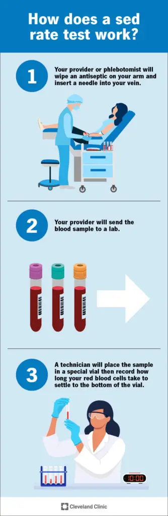 sed rate test