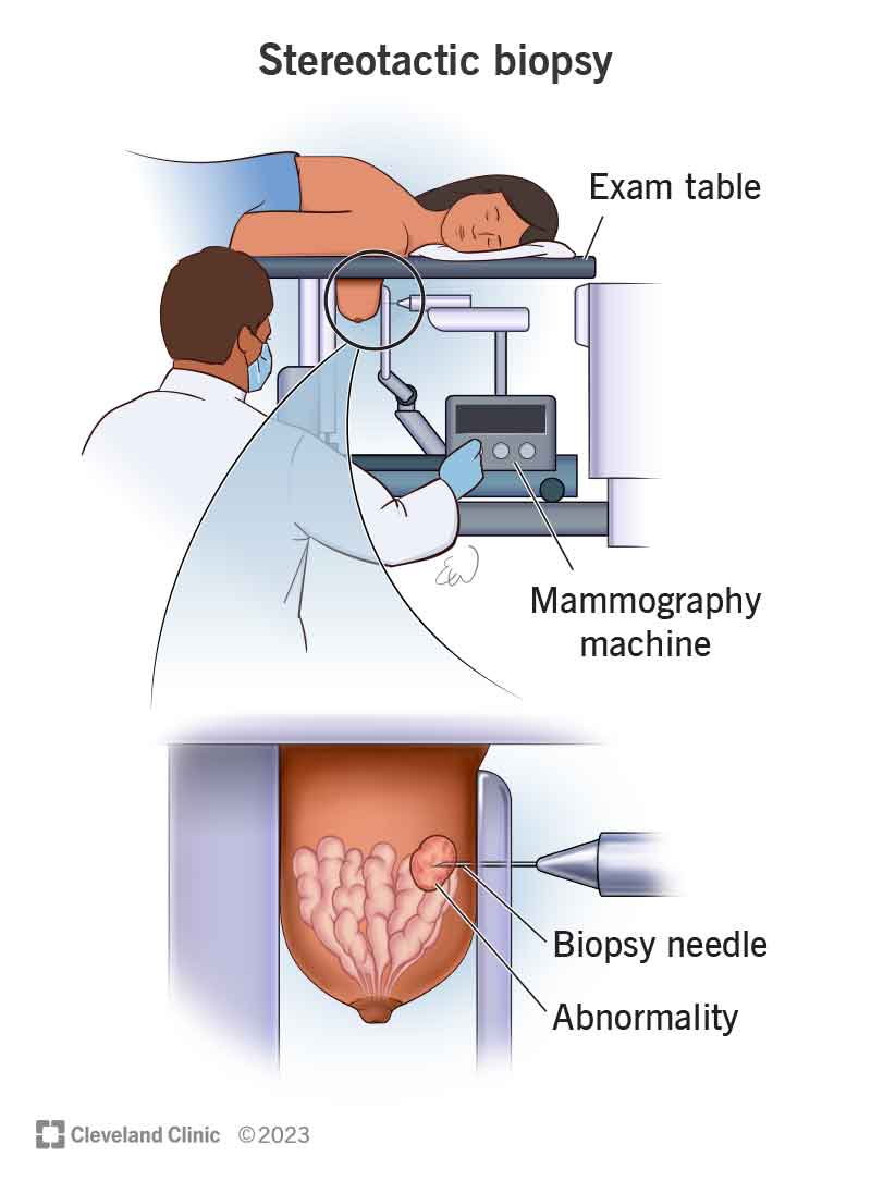 Asmuo, gulintis ant stalo stereotaksinės biopsijos metu ir stambiu planu, kai biopsijos adata pašalina audinį iš naviko.