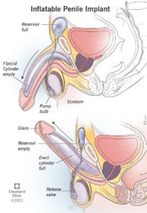 10054 penile implants