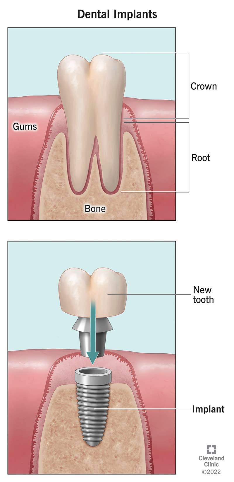 Natūralus dantis prieš dantų implantą žandikaulyje.