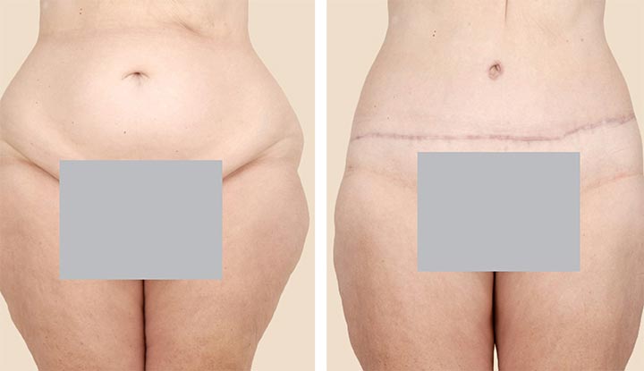 11009 liposuction