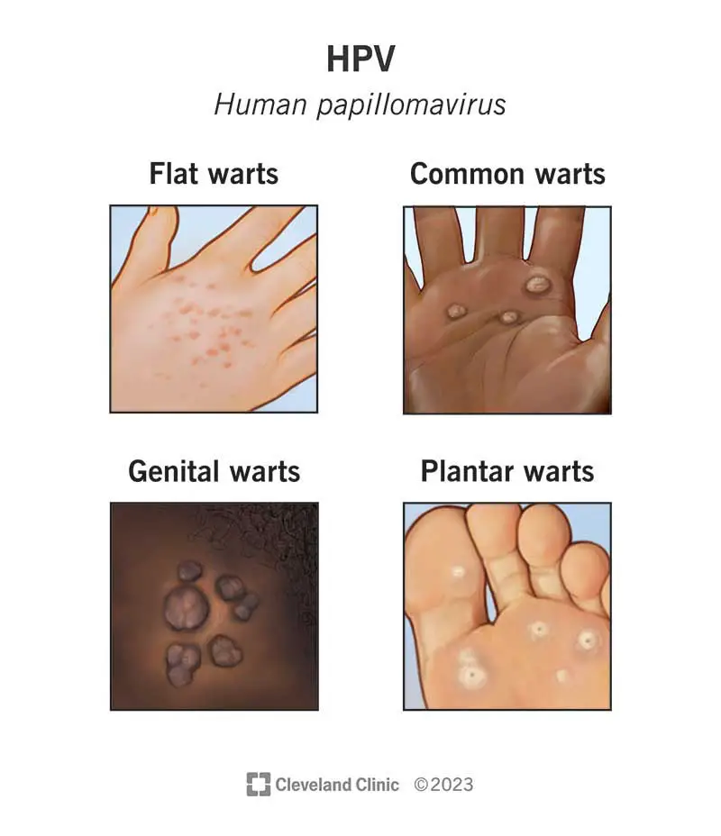 11901 hpv human papilloma virus