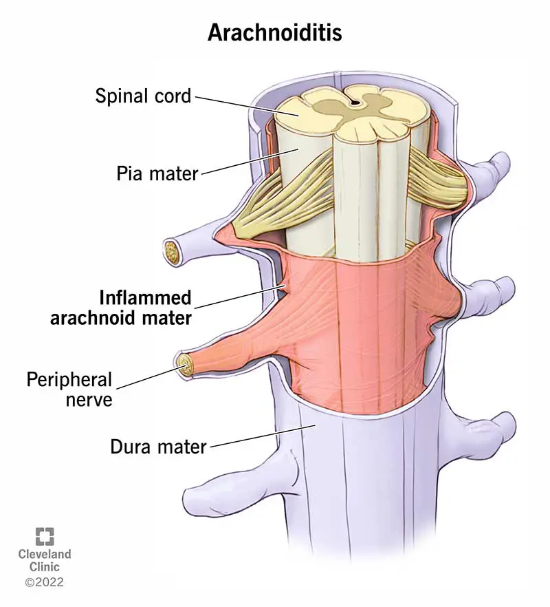 12062 arachnoiditis