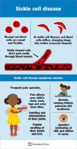 12100 sickle cell disease