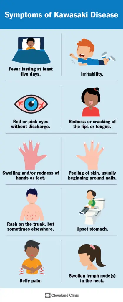 13457 kawasaki disease illustration