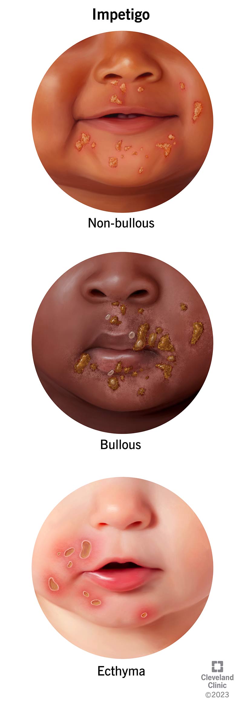 Trys impetigo stadijos: nepūslinė, pūslinė ir ektima.