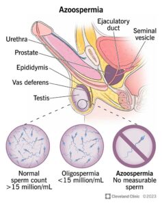 15441 azoospermia