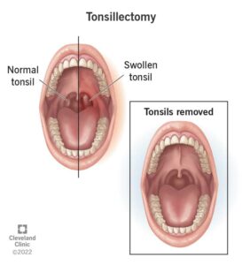 15605 tonsillectomy