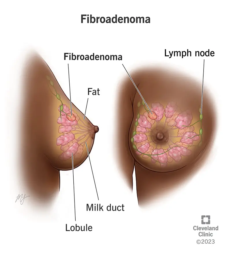 15690 fibroadenomas of the breast