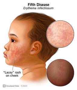 15774 fifth disease