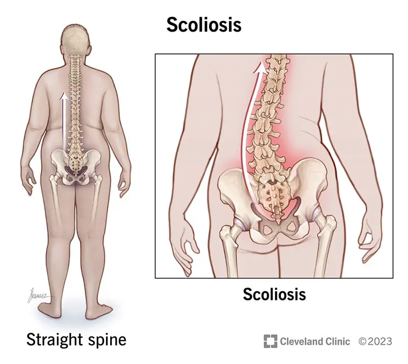 15837 scoliosis