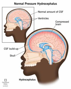 15849 hydrocephalus normal pressure