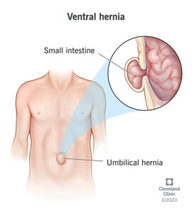 16531 ventral hernia