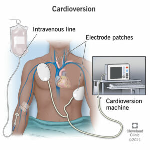 16952 cardioversion