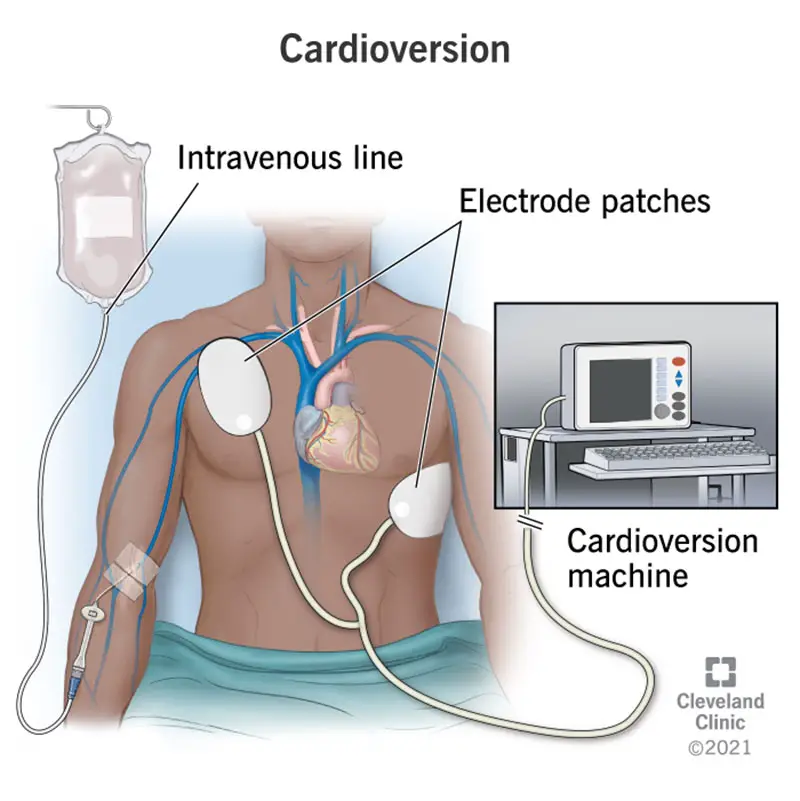 16952 cardioversion