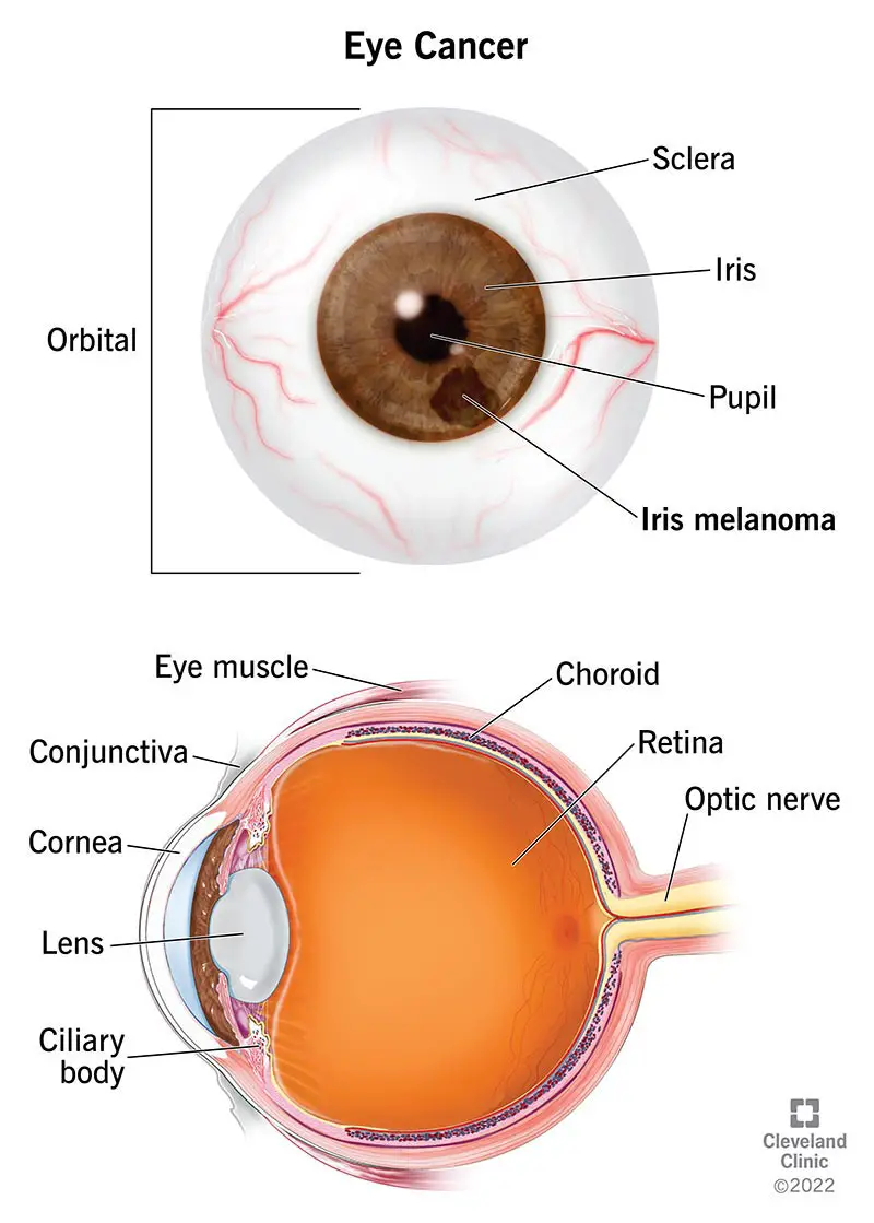 Akies obuolio su rainelės melanoma anatomijos vaizdas iš priekio ir šono.