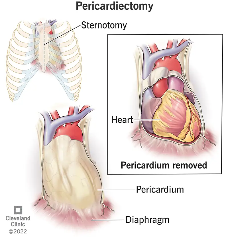 17352 pericardiectomy