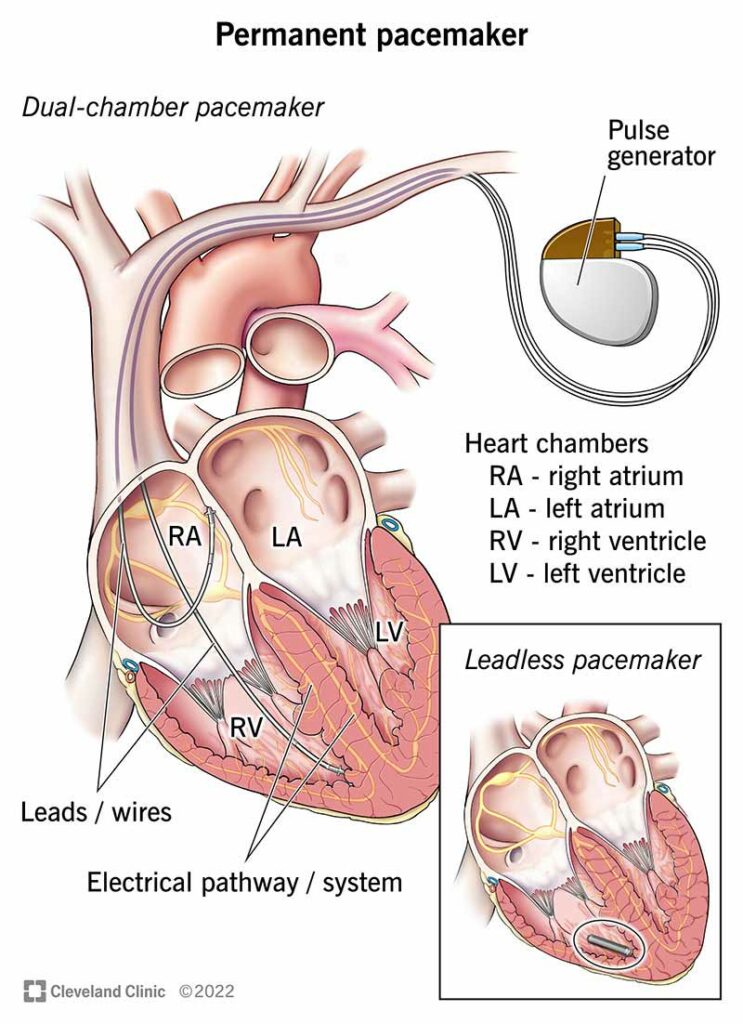 17360 permanent pacemaker