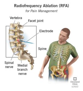 17411 radiofrequency ablation illustration