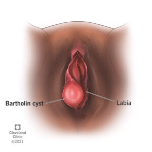 17737 bartholin cyst