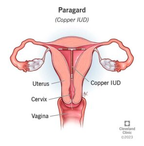 17741 paragard copper iud