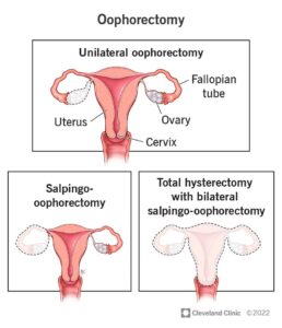 17800 oophorectomy