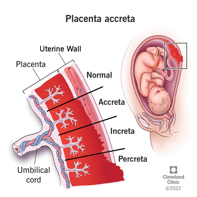 17846 placenta accreta