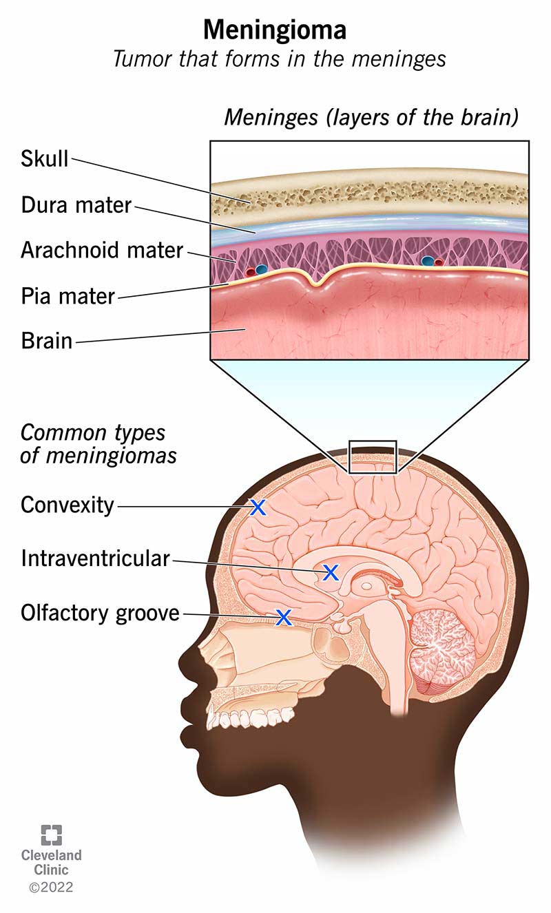 Įprasti meningiomų tipai yra išgaubtas, intraventrikulinis ir uoslės griovelis.