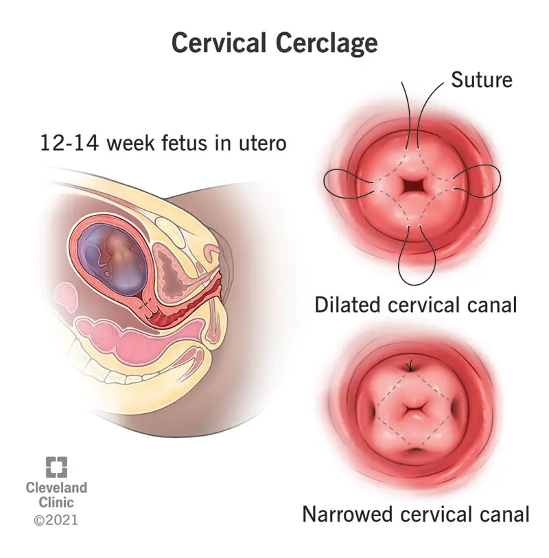 17970 cervical cerclage