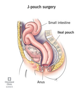 21062 j pouch surgery