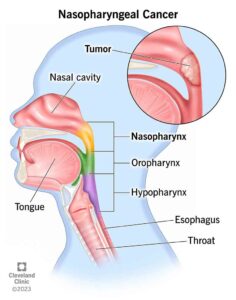 21661 nasopharyngeal cancer