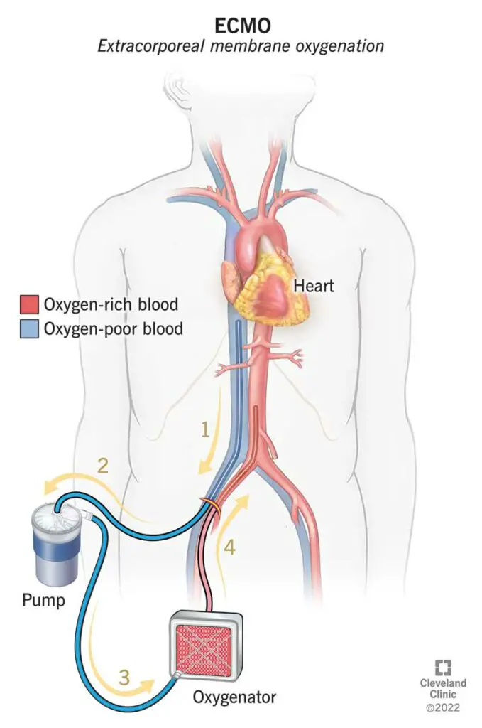 21722 ecmo illustration