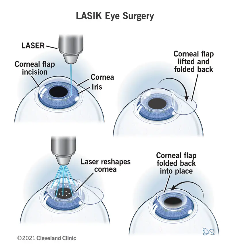 Iliustracija, kurioje pavaizduoti LASIK akių operacijos žingsniai.