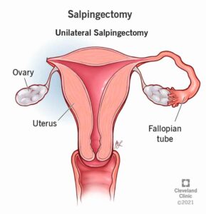 21879 salpingectomy