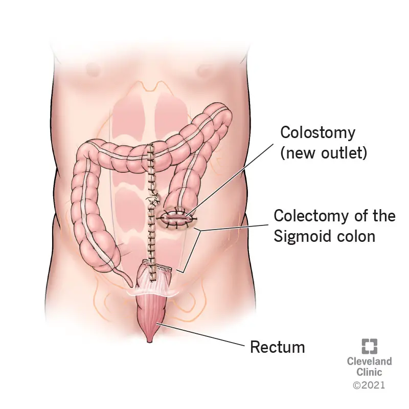 21891 hartmanns procedure illustration