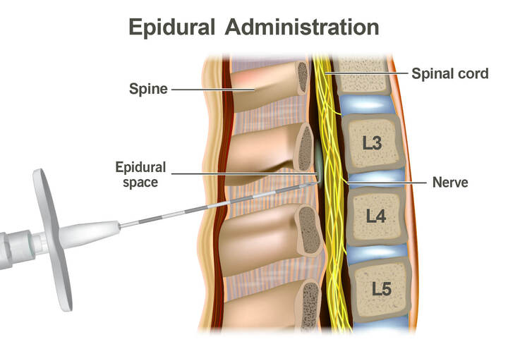 21896 epidural