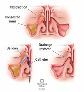 21977 balloon sinuplasty