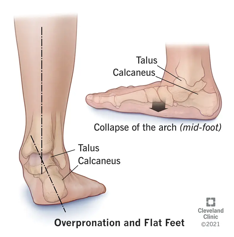 22474 overpronation