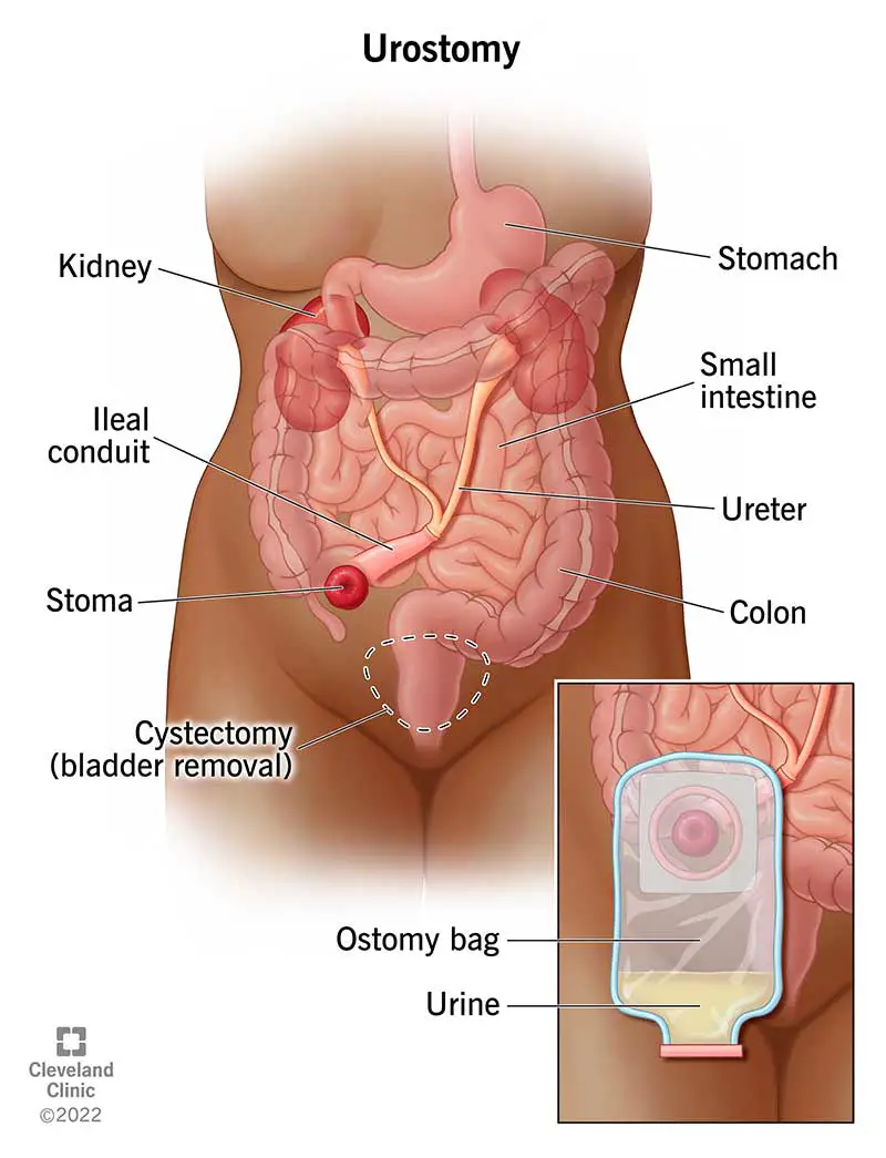 Jei pašalinta šlapimo pūslė ir atlikta urostomija, šlapimas iš inkstų patenka į šlapimtakius, klubinės žarnos kanalą, o po to stoma patenka į stomos maišelį.