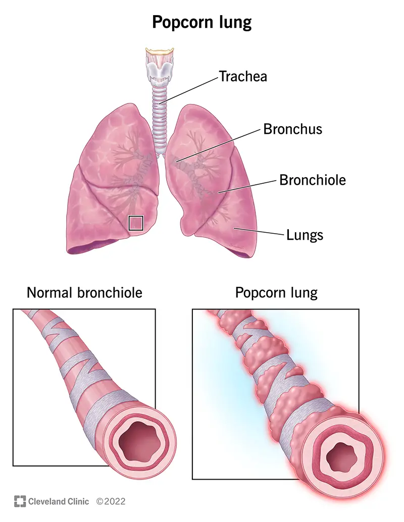 Jūsų plaučių bronchiolės yra uždegusios, randuotos ir pažeistos, sergate obliteransiniu bronchiolitu, dar vadinamu spragėsių plaučiu.