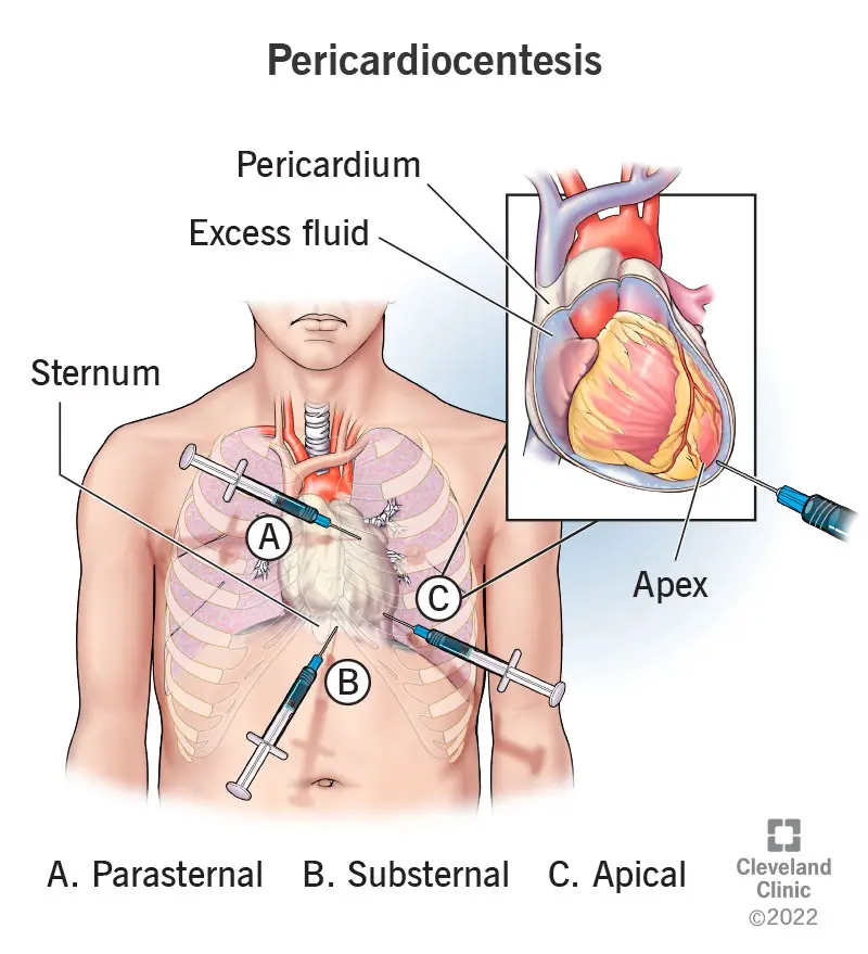 22613 pericardiocentesis