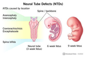 22656 neural tube defects