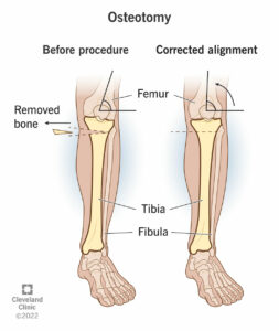 22688 osteotomy